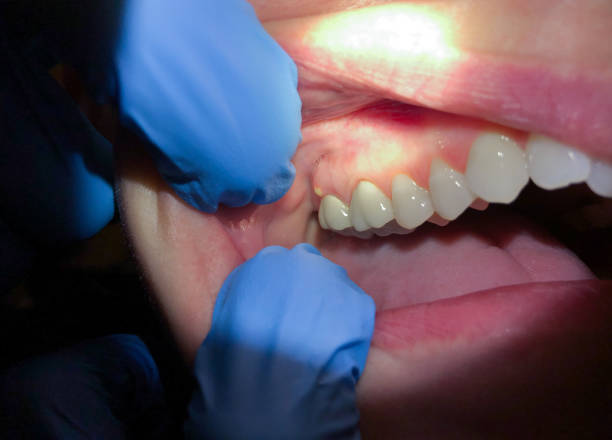 Best Tooth Infection Emergency Dentist  in Parker, AZ